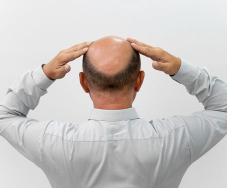 bold-man-needing-follicular-unit-extraction